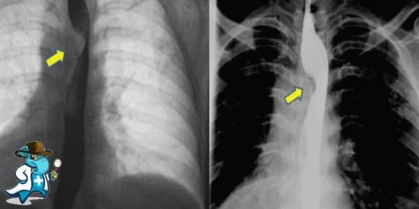 ¿Puedo Contratar un Seguro Médico si Tengo Disfagia Lusoria en España?