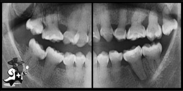 ¿Puedo Contratar un Seguro Médico si Tengo Displasia de la Dentina en España?