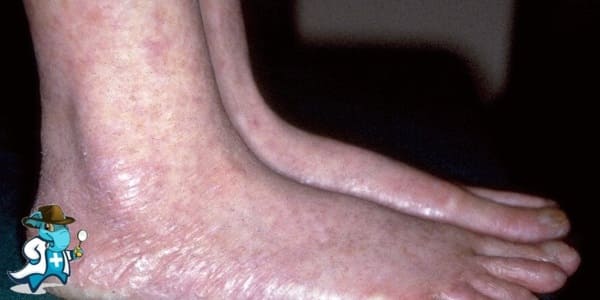 ¿Puedo Contratar un Seguro Médico si Tengo Disqueratosis Congénita en España?