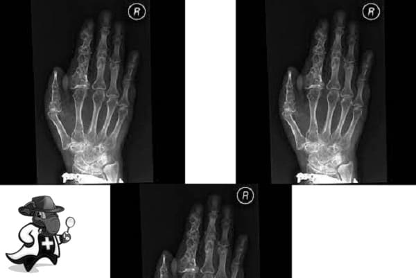 ¿Puedo Contratar un Seguro Médico si Tengo Enfermedad de Ollier en España?