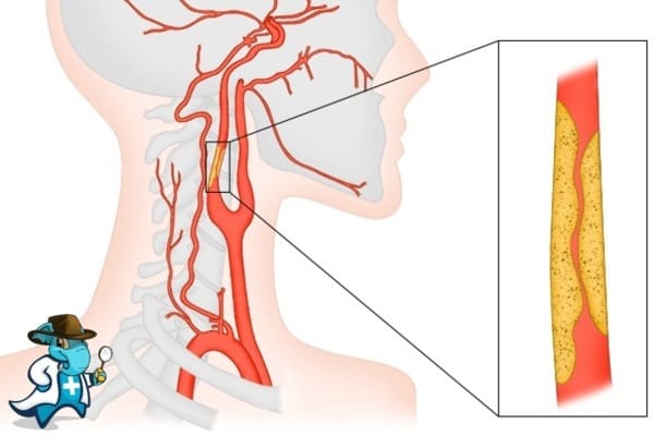 ¿Puedo Contratar un Seguro Médico si Tengo Estenosis de Arteria Carótida en España?