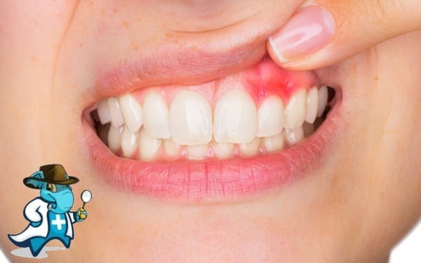 ¿Puedo Contratar un Seguro Médico si Tengo Gingivitis en España?