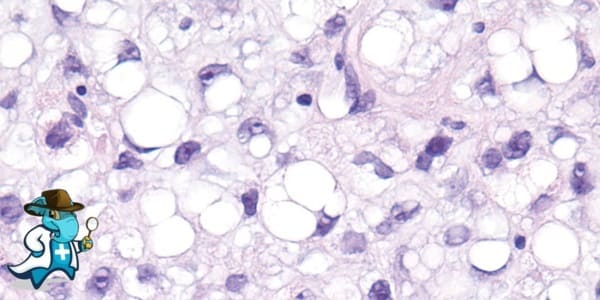 ¿Puedo Contratar un Seguro Médico si Tengo Liposarcoma Desdiferenciado en España?