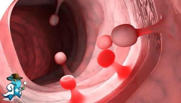 ¿Puedo Contratar un Seguro Médico si Tengo Pólipos de colon en España?