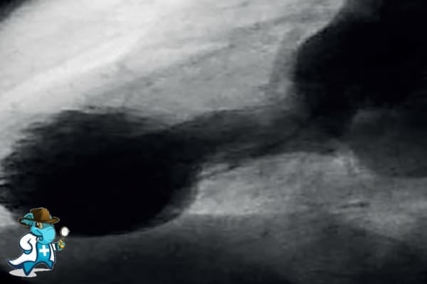 ¿Puedo Contratar un Seguro Médico si Tengo Síndrome de Tako-Tsubo en España?