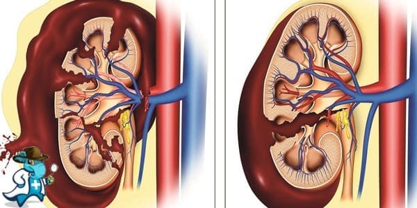 ¿Puedo Contratar un Seguro Médico si Tengo Traumatismo Renal en España?
