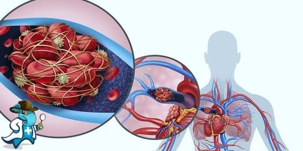 ¿Puedo Contratar un Seguro Médico si Tengo Trombo Embolismo Pulmonar en España?