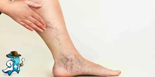 ¿Puedo Contratar un Seguro Médico si Tengo Trombosis Venosa en España?