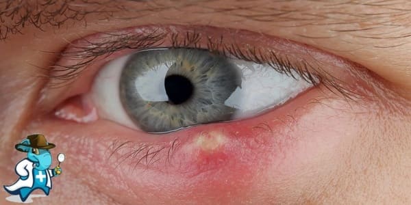 ¿Puedo Contratar un Seguro Médico si tengo Dacrioadenitis en España?