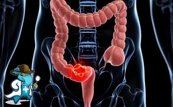 ¿Puedo Ocultar que Tengo Cáncer Colorrectal Para Contratar el Seguro Médico en España?