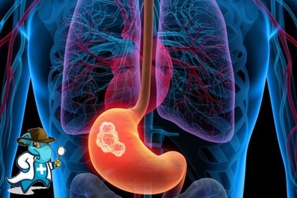 ¿Puedo Contratar un Seguro Médico si Tengo Cáncer de Estómago en España?