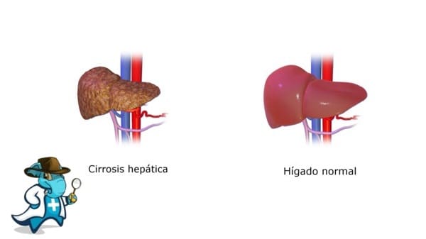 ¿Puedo Ocultar que Tengo Cirrosis Hepática Para Contratar el Seguro Médico en España?