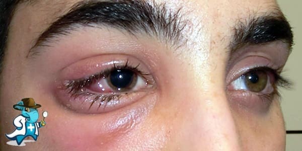 ¿Puedo Ocultar que Tengo Dacrioadenitis para Contratar el Seguro Médico en España?