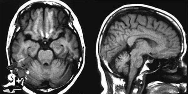 ¿Puedo Ocultar que Tengo Degeneración Cerebelosa para Contratar el Seguro Médico en España?