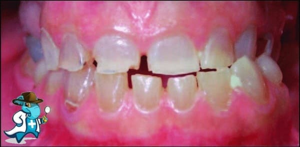 ¿Puedo Ocultar que Tengo Dentinogénesis Imperfecta Para Contratar el Seguro Médico en España?