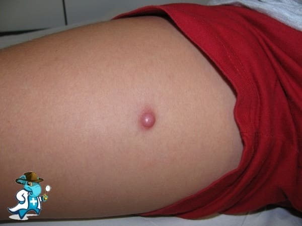 ¿Puedo Ocultar que Tengo Dermatofibrosarcoma Para Contratar el Seguro Médico en España?