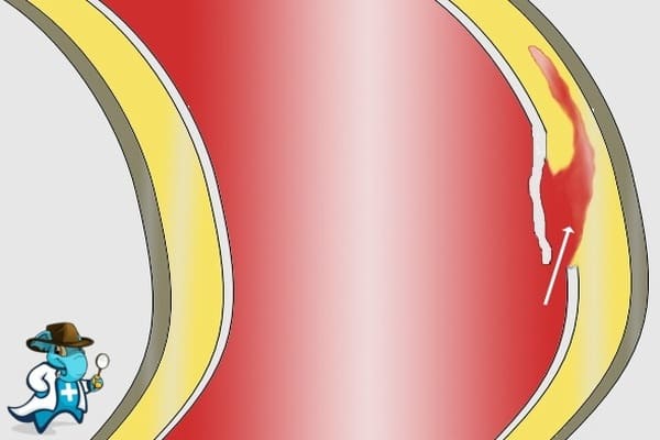 ¿Puedo Ocultar que Tengo Disección de la Aorta para Contratar el Seguro Médico en España?