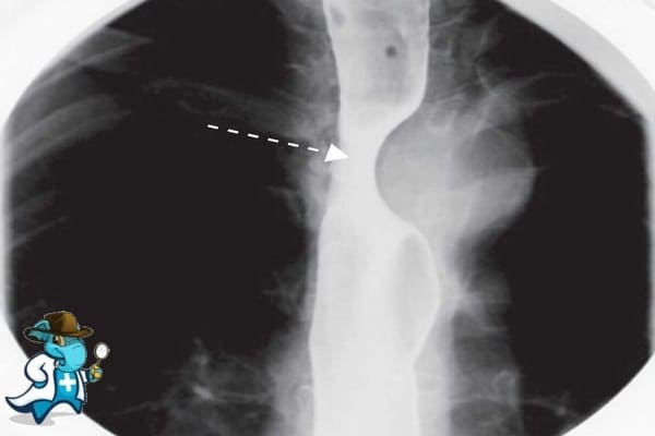 ¿Puedo Ocultar que Tengo Disfagia Lusoria para Contratar el Seguro Médico en España?