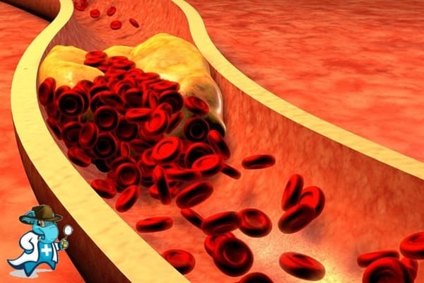 ¿Puedo Ocultar que Tengo Dislipidemia Rara para Contratar el Seguro Médico en España?