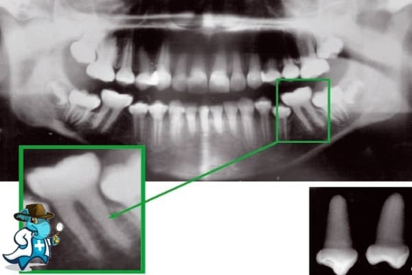 ¿Puedo Ocultar que Tengo Displasia de la Dentina para Contratar el Seguro Médico en España?