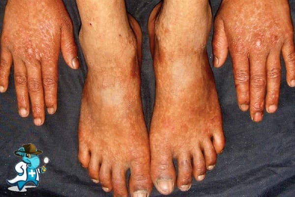 ¿Puedo Ocultar que Tengo Disqueratosis Congénita para Contratar el Seguro Médico en España?