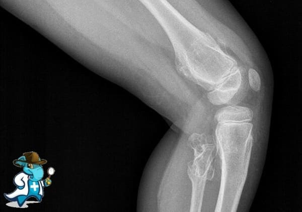 ¿Puedo Ocultar que Tengo Enfermedad de Ollier Para Contratar el Seguro Médico en España?