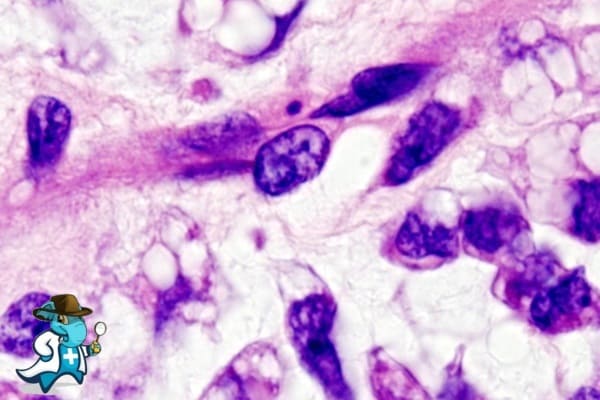 ¿Puedo Ocultar que Tengo Liposarcoma Desdiferenciado para Contratar el Seguro Médico en España?