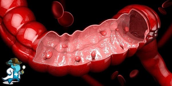 ¿Puedo Ocultar que Tengo Pólipos de Colon Para Contratar el Seguro Médico en España?