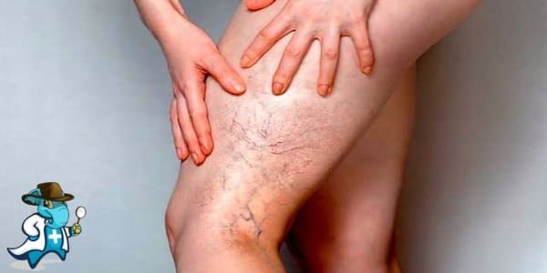 ¿Puedo Ocultar que Tengo Trombosis Venosa para Contratar el Seguro Médico en España?