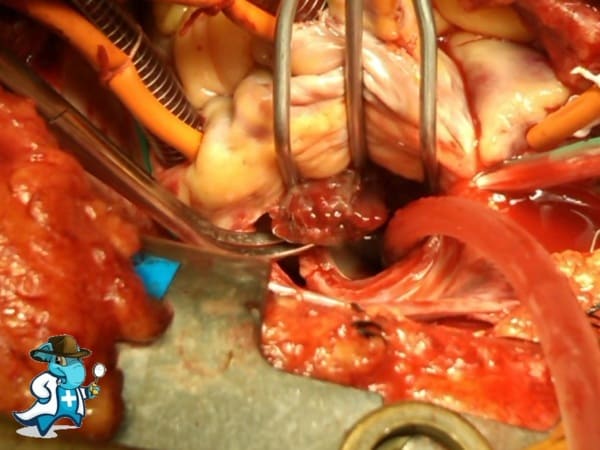 ¿Puedo Ocultar que Tengo Tumores Cardiacos para Contratar el Seguro Médico en España?