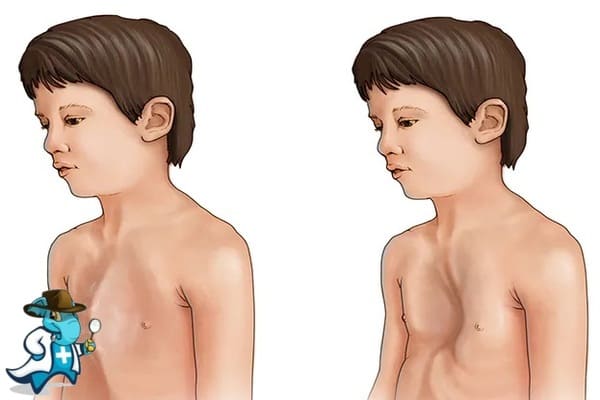 ¿Puedo Ocultar que Tengo el Síndrome de Marfan para Contratar el Seguro Médico en España?