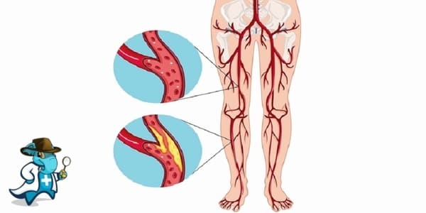 ¿Puedo Ocultar que Tengo la Enfermedad Vascular Periférica para Contratar el Seguro Médico en España?
