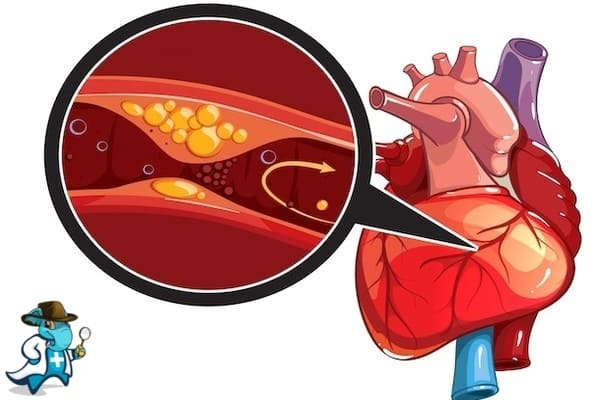 ¿Puedo Ocultar que Tengo la Enfermedad de las Arterias Coronarias para Contratar el Seguro Médico en España?