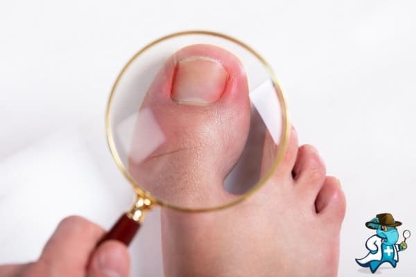 ¿Cubre el Seguro Médico el Matricoma Onicocítico en España?