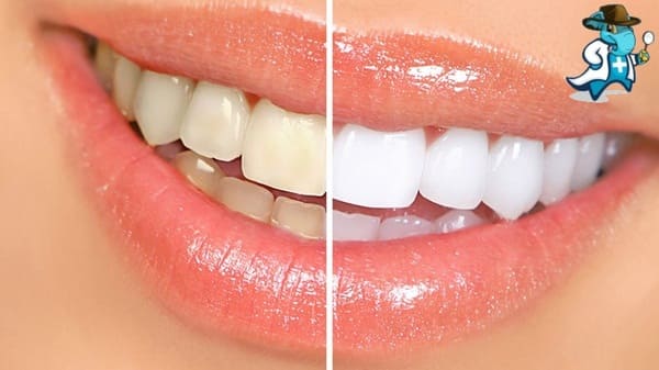 Blanqueamiento en la Clínica Dental Álava