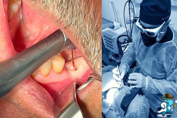 Implantología y Cirugía Clínica Dental Tiz-Tuz en Álava 