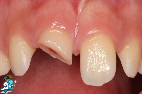 Traumatismo Dentario Clínica Dental Tiz-Tuz en Álava 