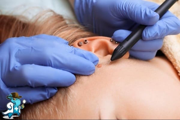 Eliminación de verrugas y Nevus