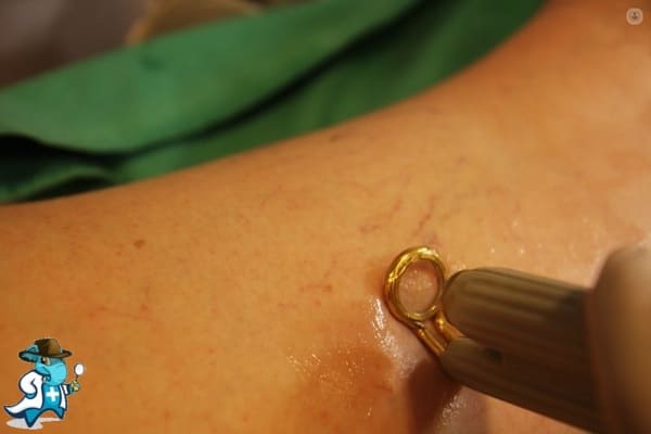 Tratamiento de varices y arañas vasculares