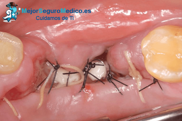 Tratamientos quirúrgicos con Plasma Rico en Factores de Crecimiento prevención en salud (PRGF) en la Clínica Dental Álava.